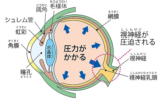 視界が欠ける？緑内障とは