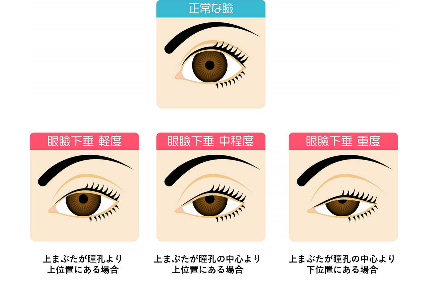 眼瞼下垂の診断方法